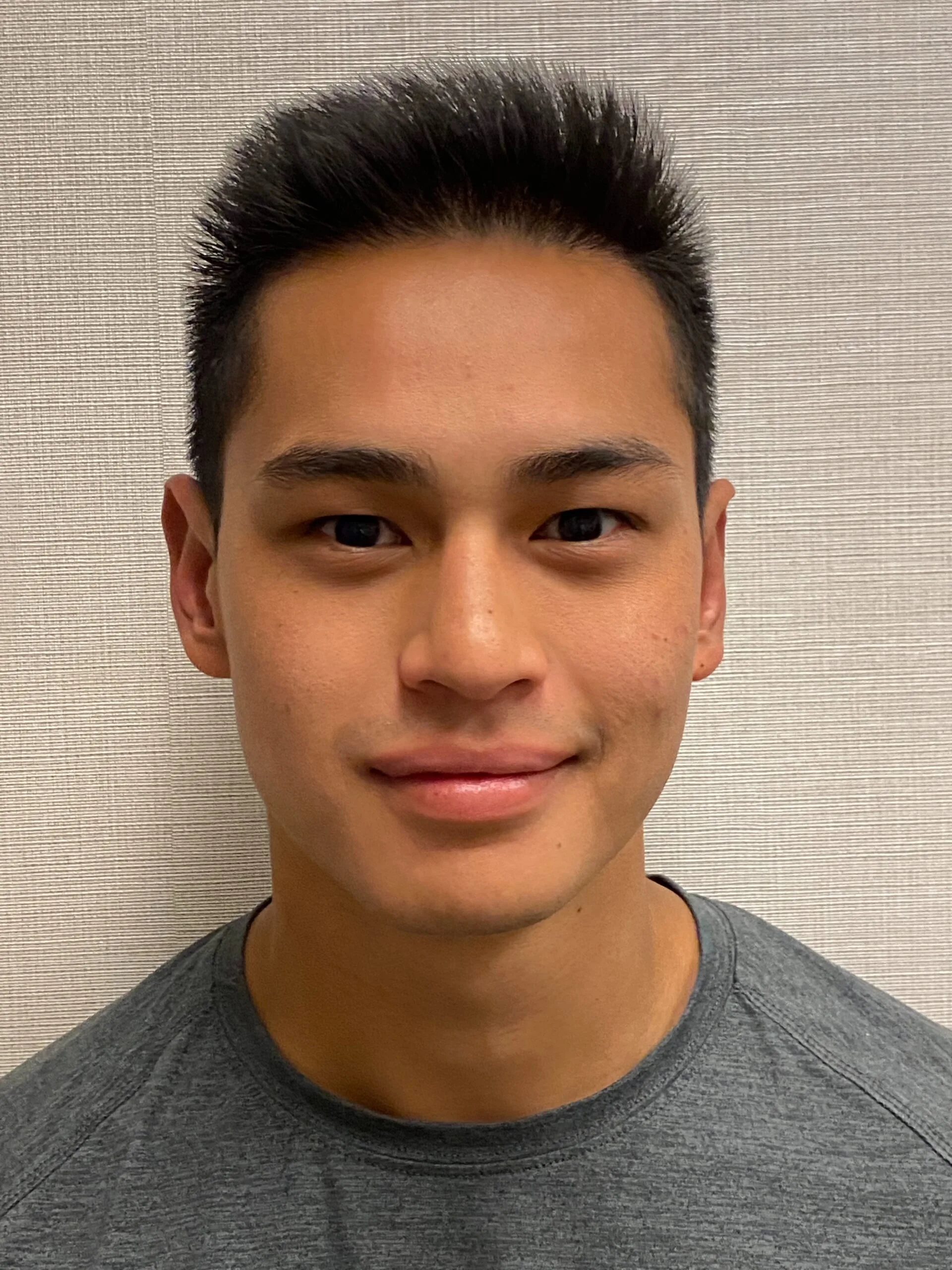 Otoplasty-Case--2681 | After Otoplasty 1