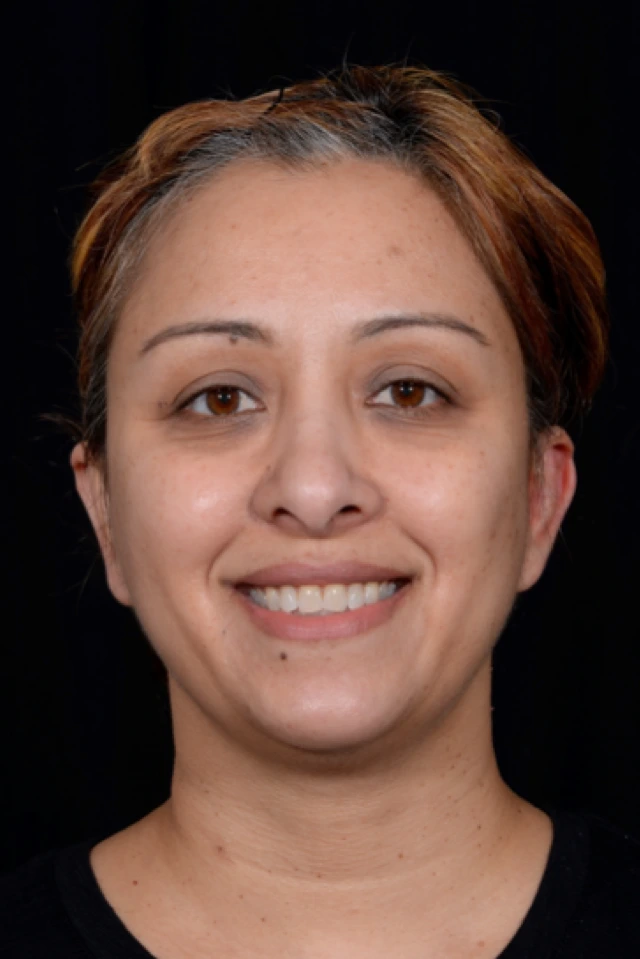 Otoplasty-Case--4655 | After Otoplasty 1