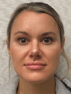 Rhinoplasty-Case--4972 | After Dr. Arjun Kanuri 1