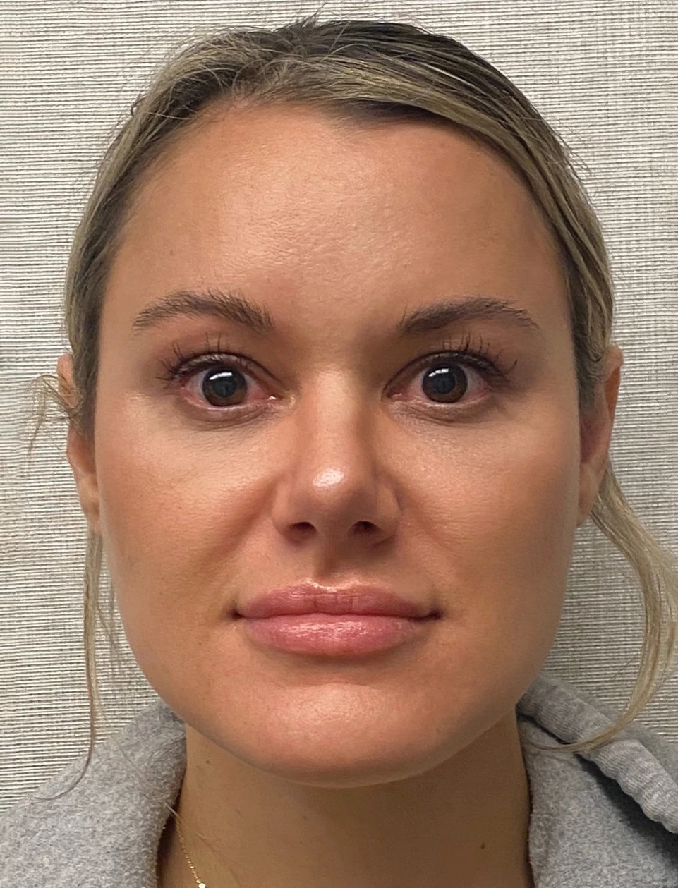 Rhinoplasty-Case--4972 | After Rhinoplasty 1