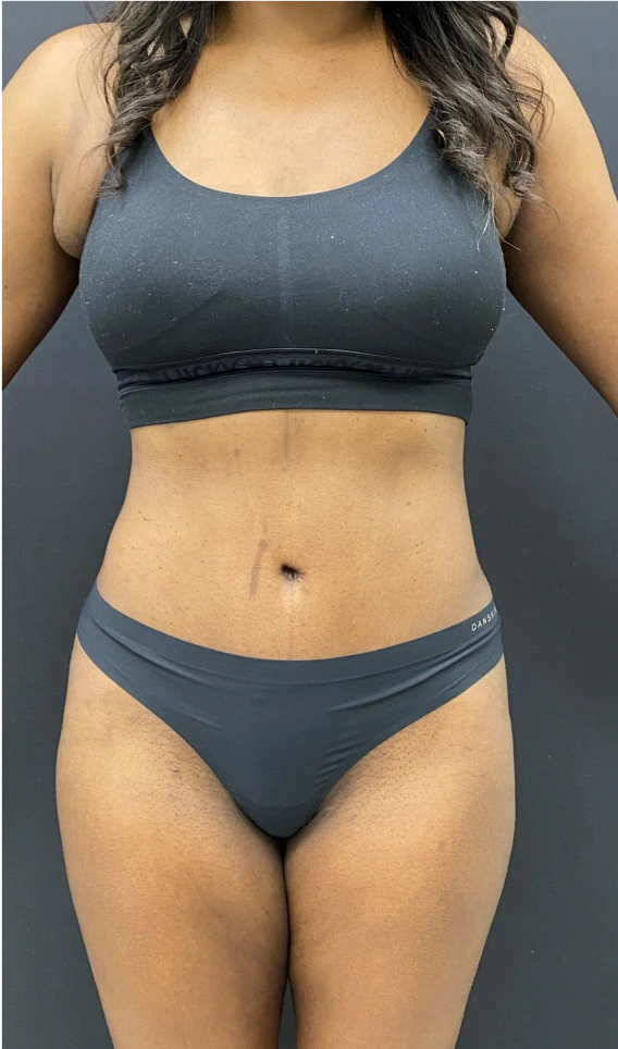 Abdominoplasty-Case--6650 | After Liposuction 1