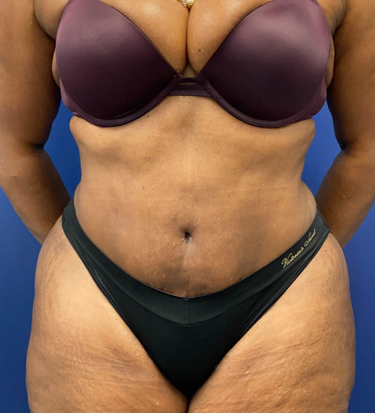 Abdominoplasty-Case--4427 | After Tummy Tuck 1