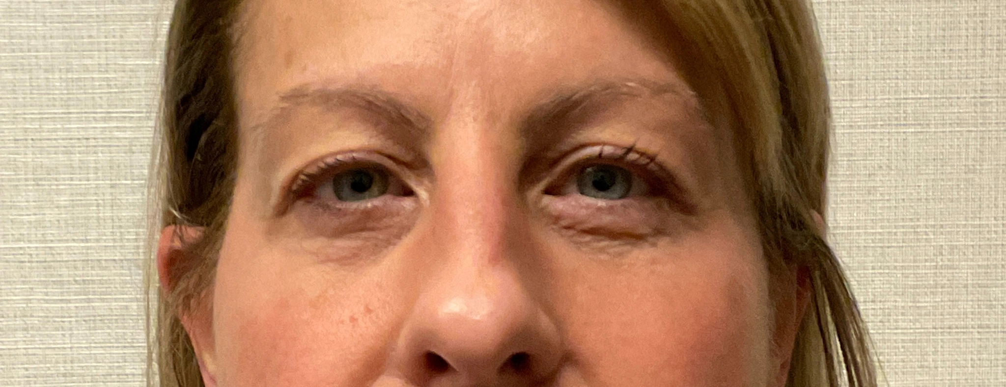 Upper-Blepharoplasty-Case--7202 | After Eyelid Surgery 1