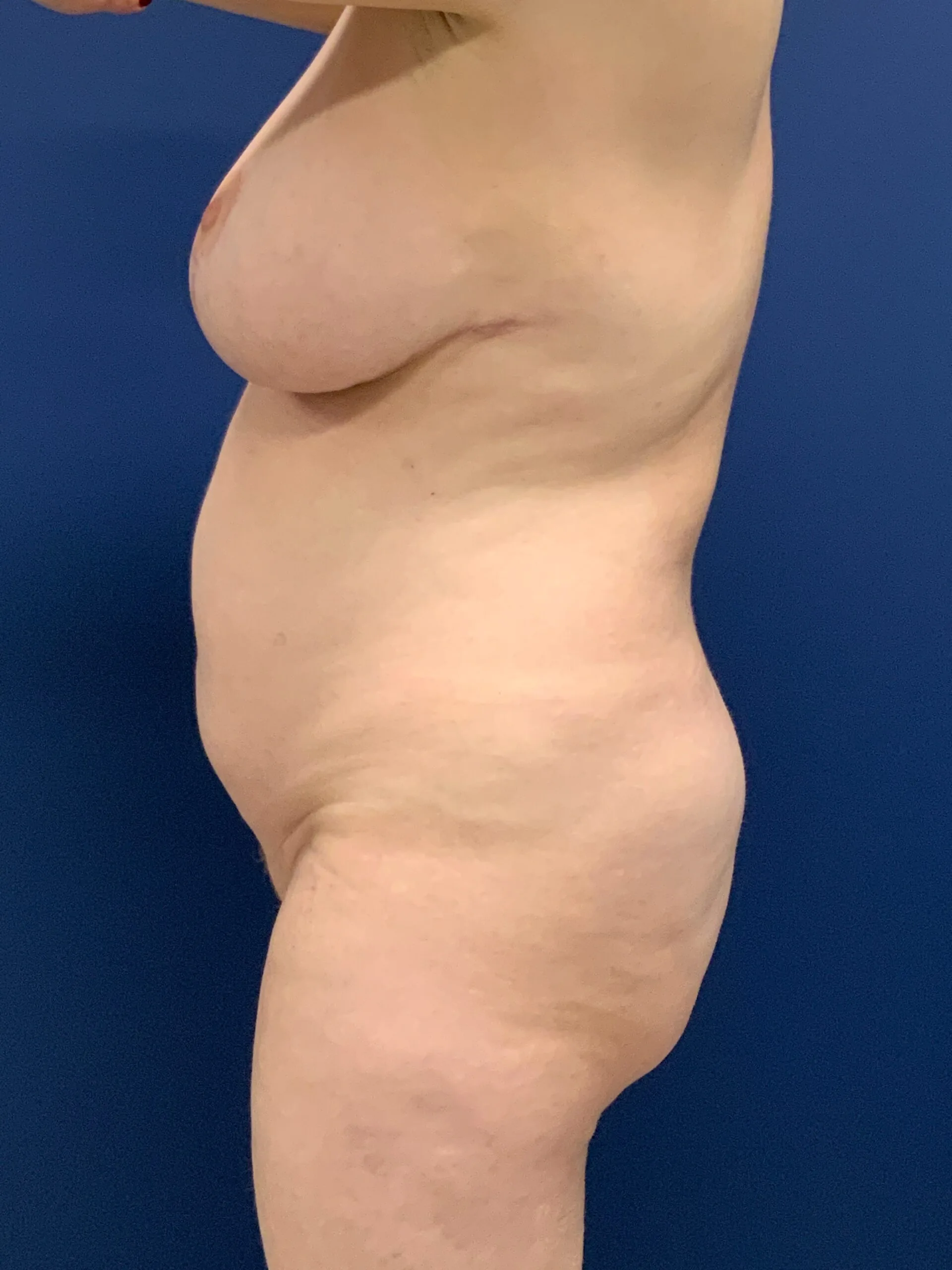 Breast-Reduction-Case--2878 | After Breast Reduction 2