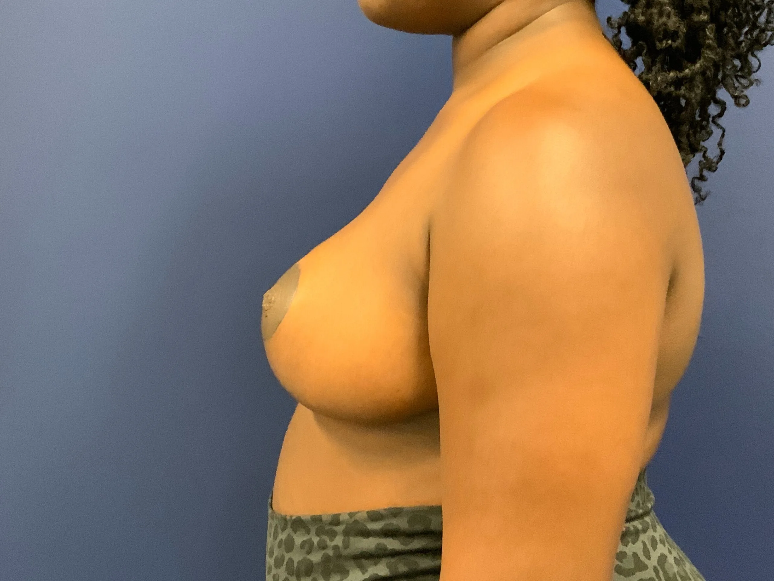 Breast-Reduction-Case--7783 | After Breast Reduction 3
