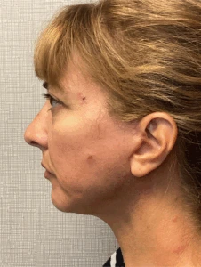 Facelift-Case--8368 | After Facelift 2