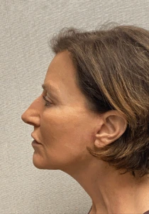 Facelift-Case--6591 | After Facelift 2