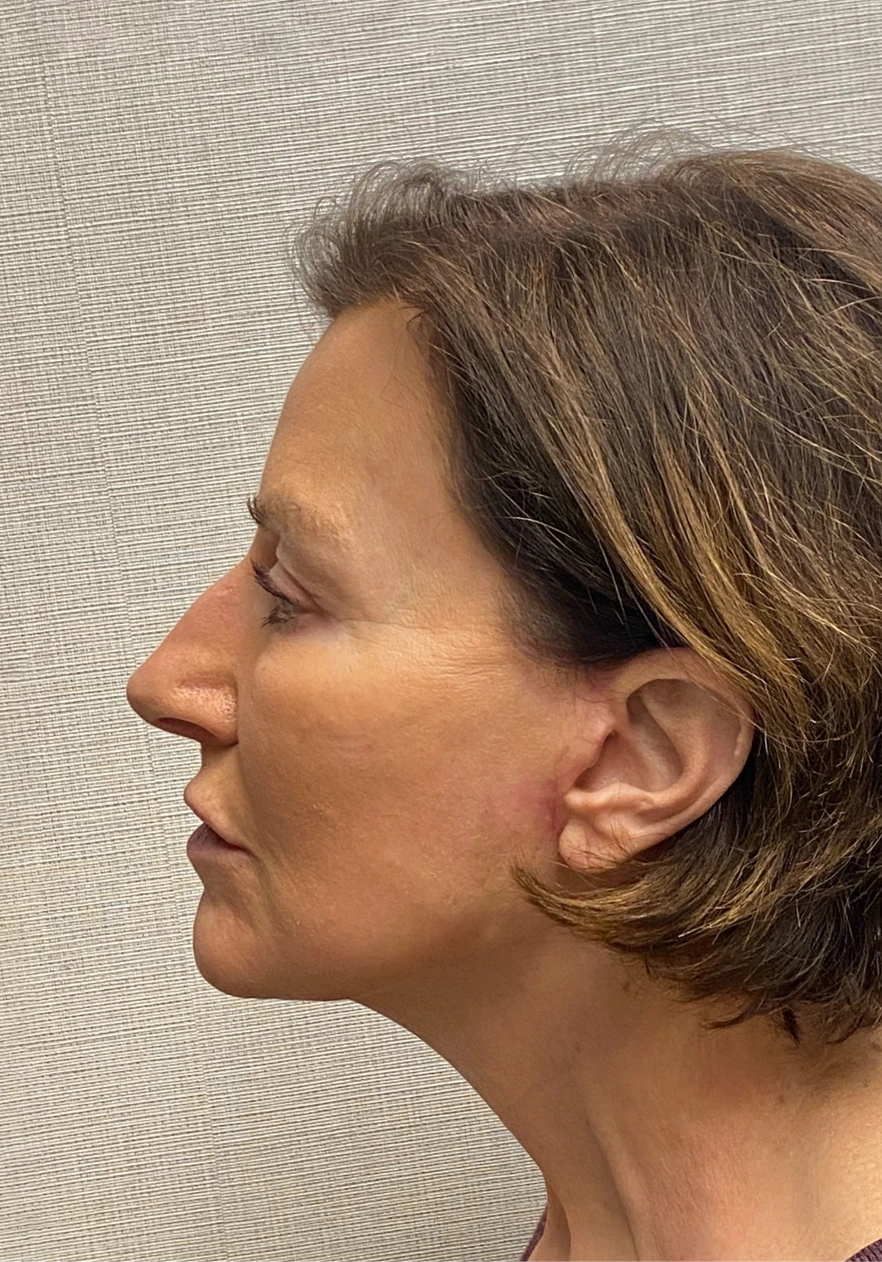 Facelift-Case--6591 | After Facelift 2