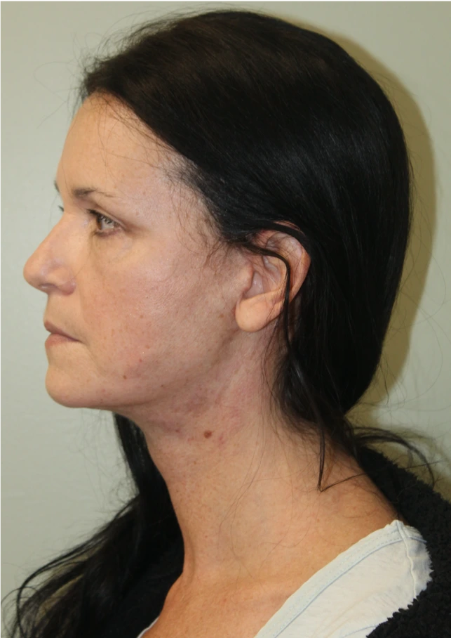 Face-and-Neck-Lift-Case--9403 | After Facelift 3