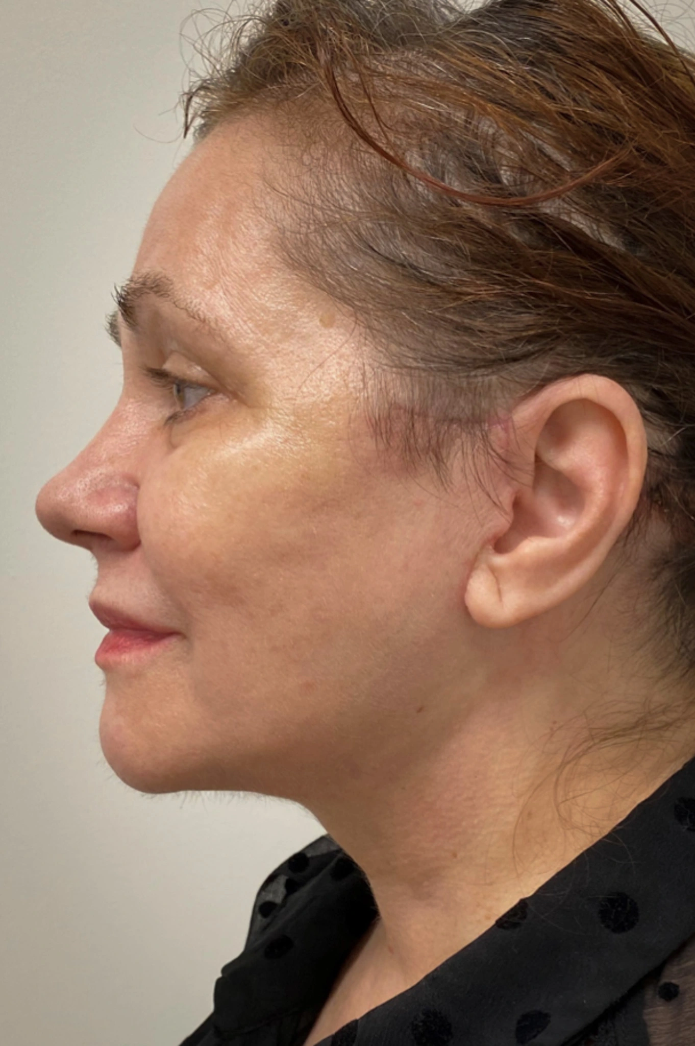 Facelift-Case--6254 | After Facelift 2