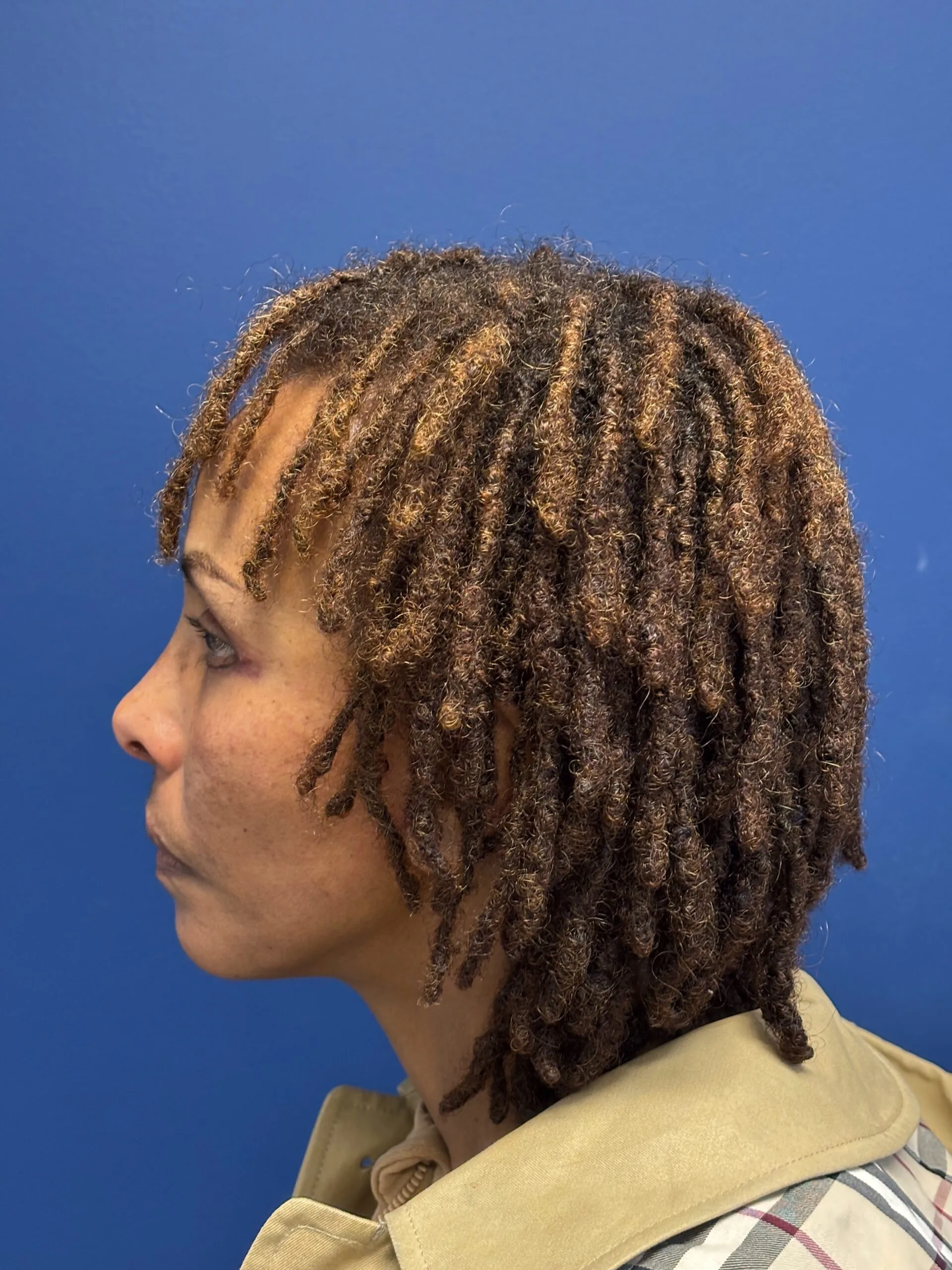 Facelift-Case--1863 | After Facelift 3