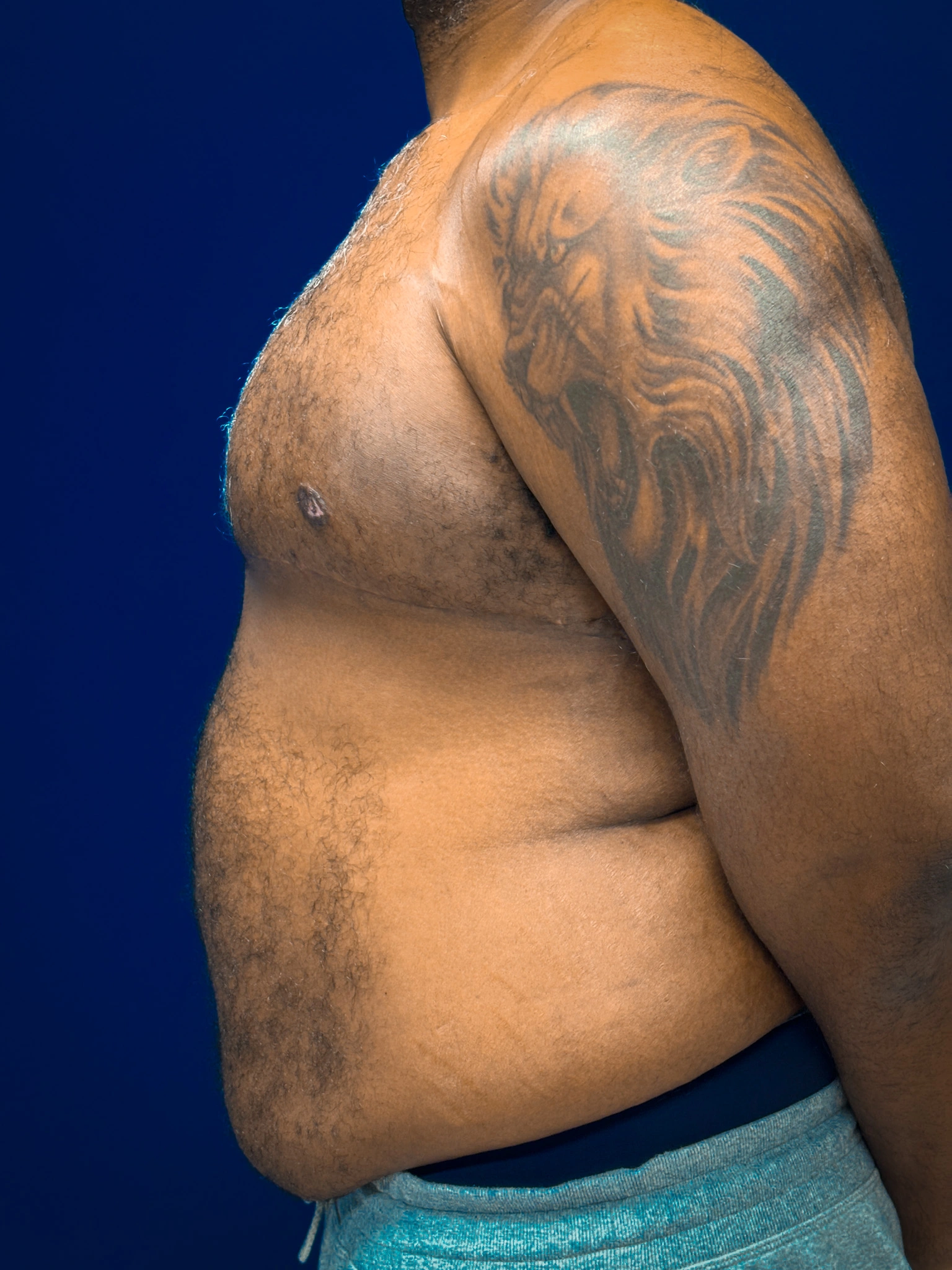 Gynecomastia-Case--4473 | After Gynecomastia / Male Breast Reduction 3