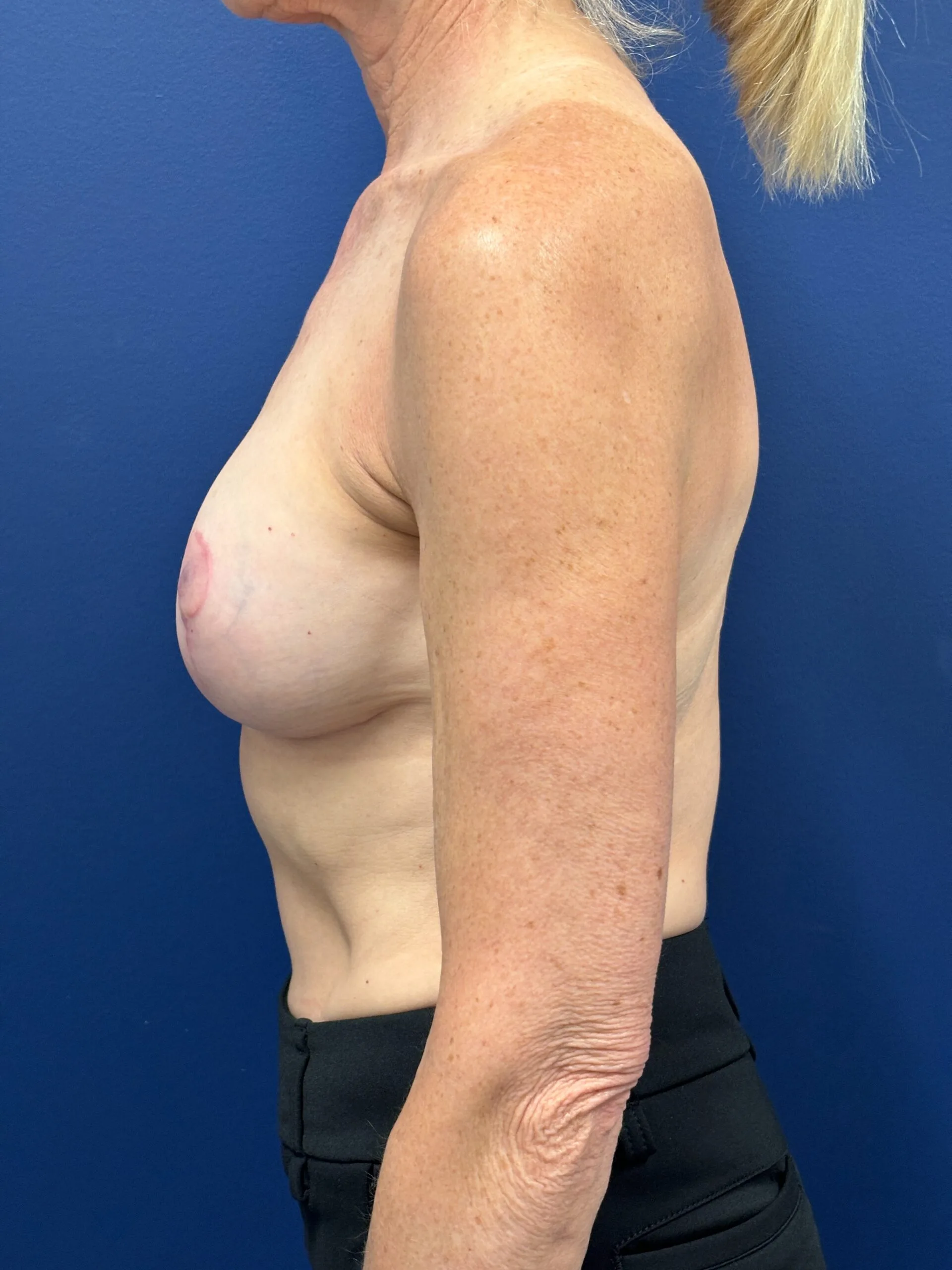 Revision-Breast-Augmentation-Case--9027 | After Revision Augmentation 3