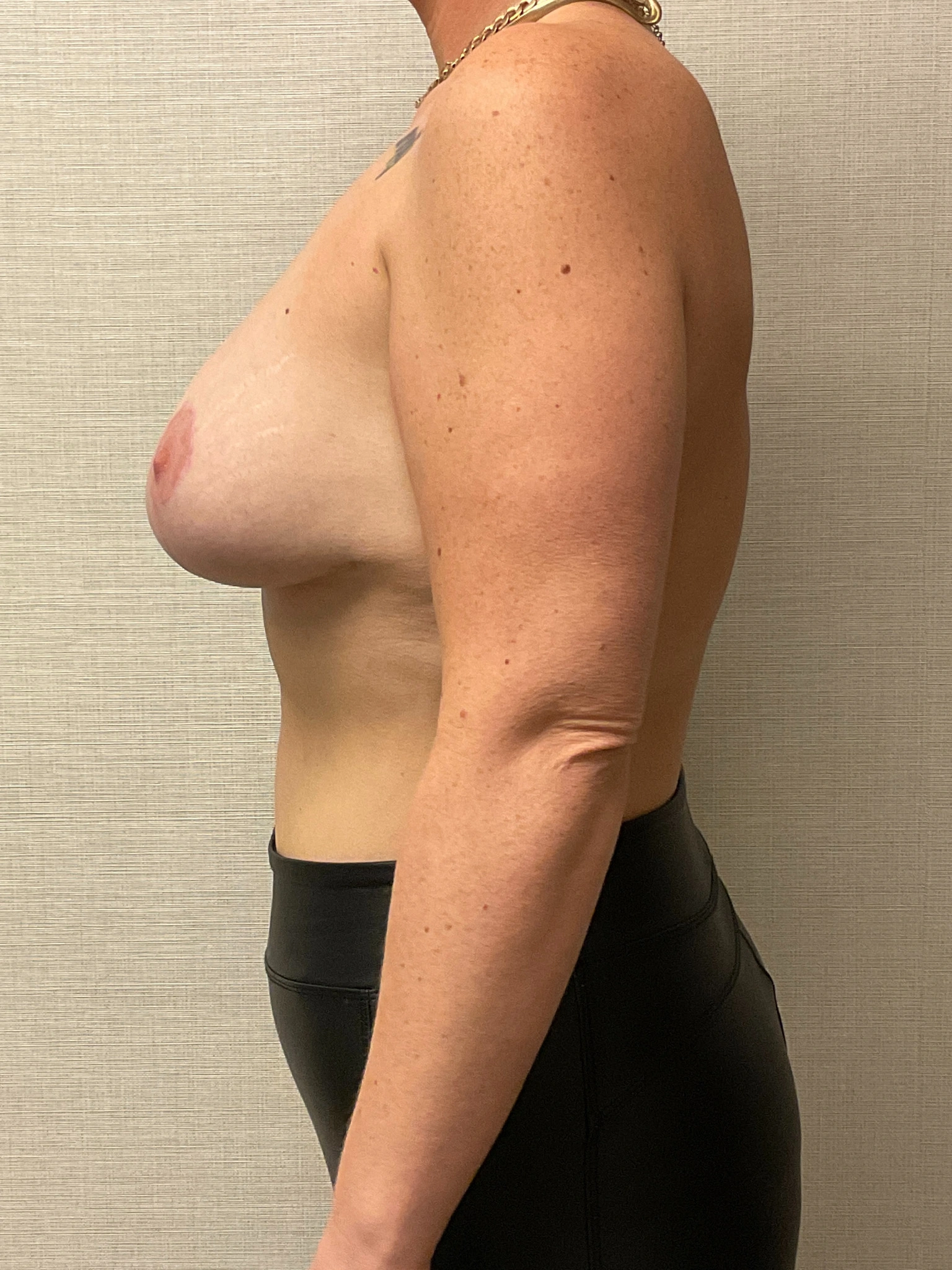 Augmentation-Mastopexy-Case--6658 | After Breast Augmentation With Lift 3