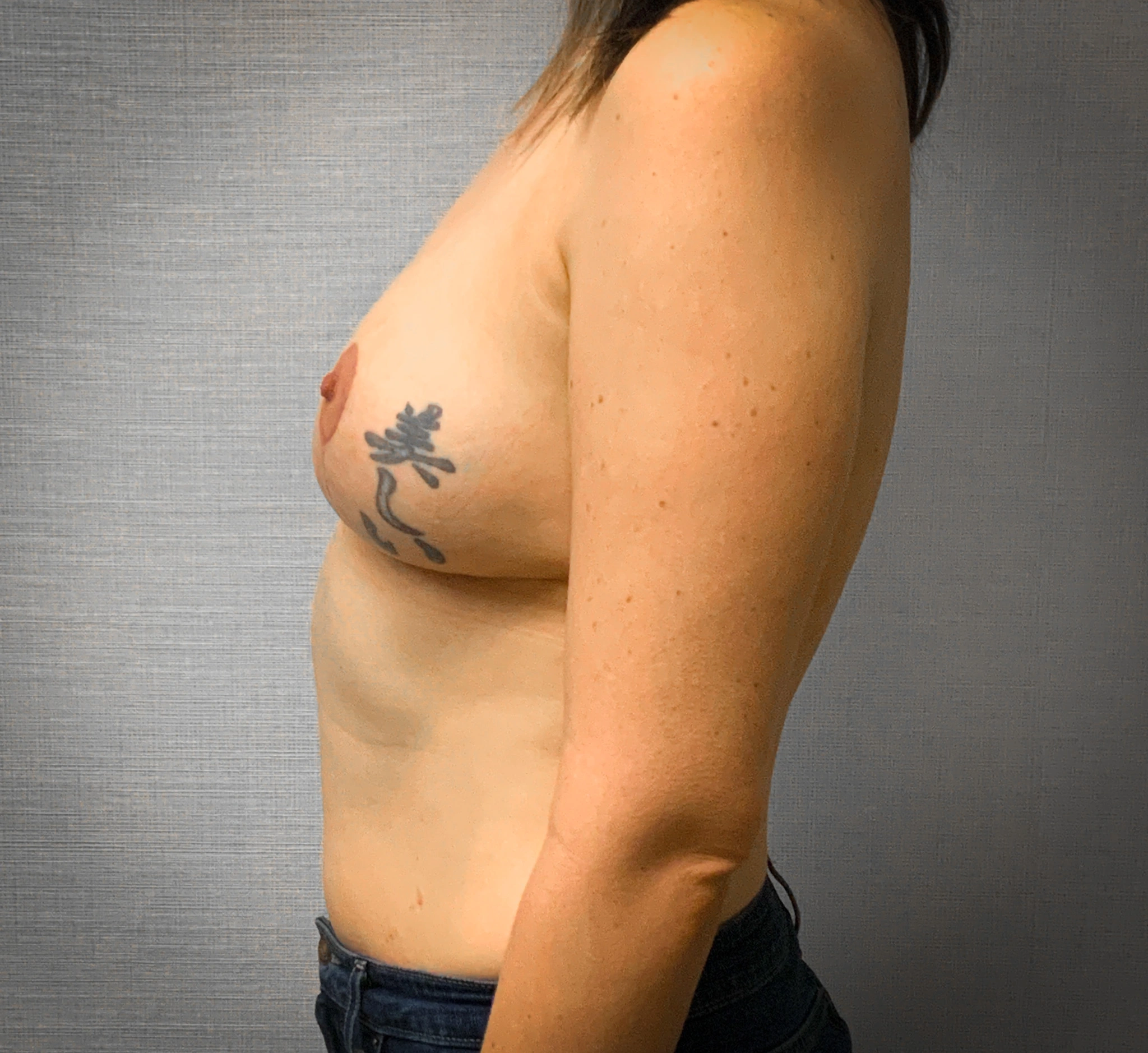 Mastectomy-Case--2847 | After Breast Lift 2