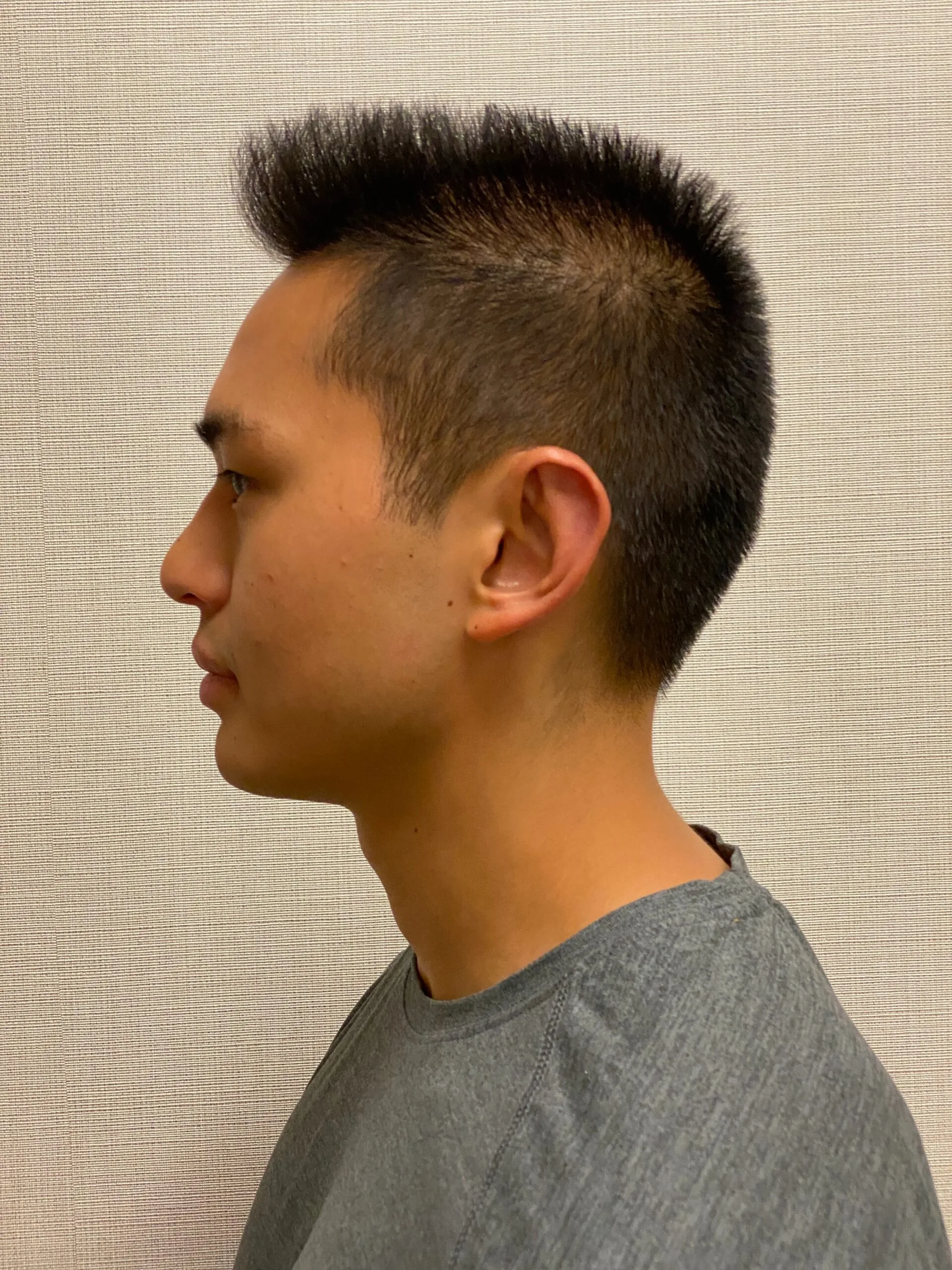 Otoplasty-Case--2681 | After Otoplasty 2