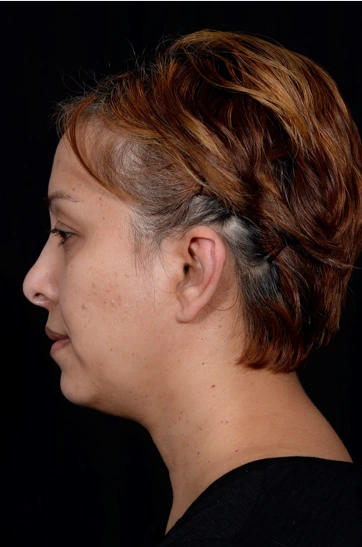 Otoplasty-Case--4655 | After Otoplasty 3