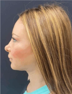 Facelift-and-Facial-Fat-Grafting-Case--1679 | After Facial Fat Grafting 2