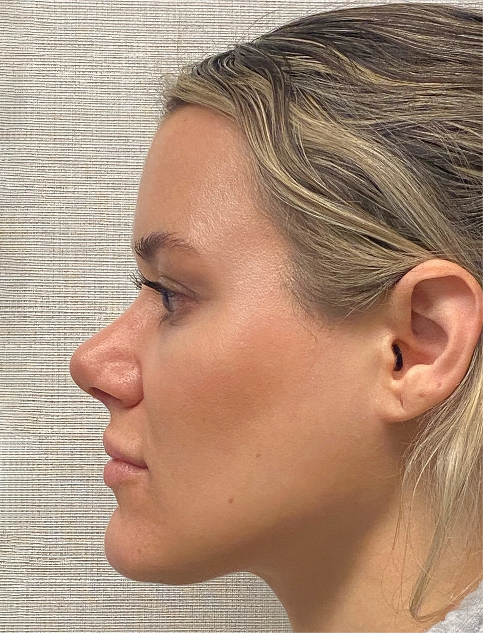 Rhinoplasty-Case--4972 | After Rhinoplasty 4