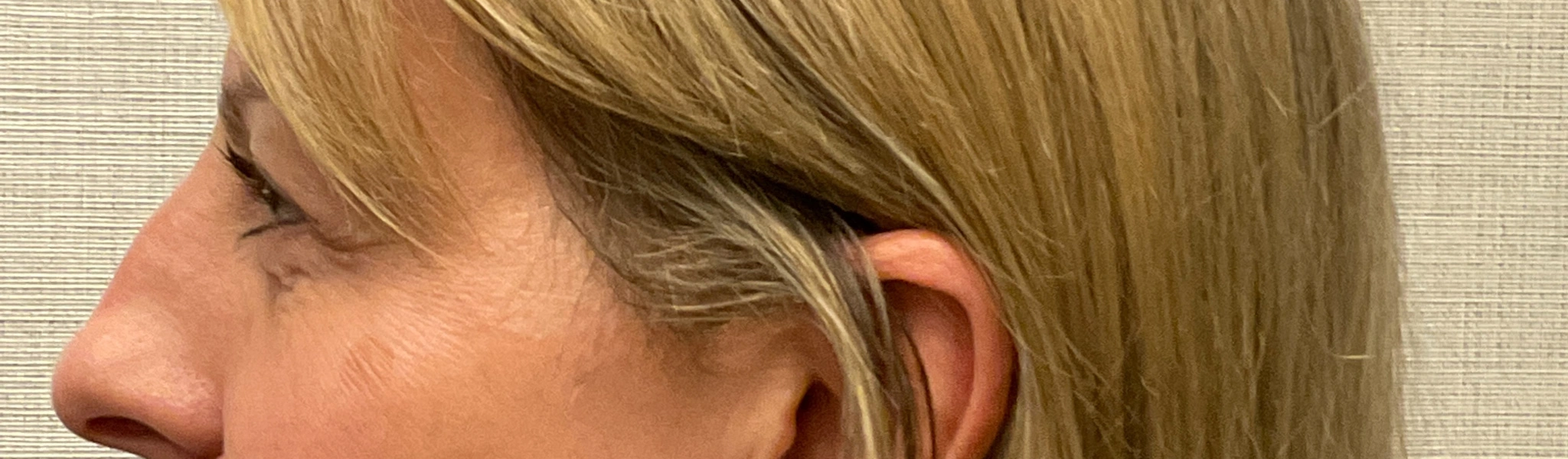 Upper-Blepharoplasty-Case--7202 | Before Eyelid Surgery 3