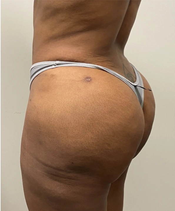Brazilian-Butt-Lift-Case--7979 | After Brazilian Butt Lift 3