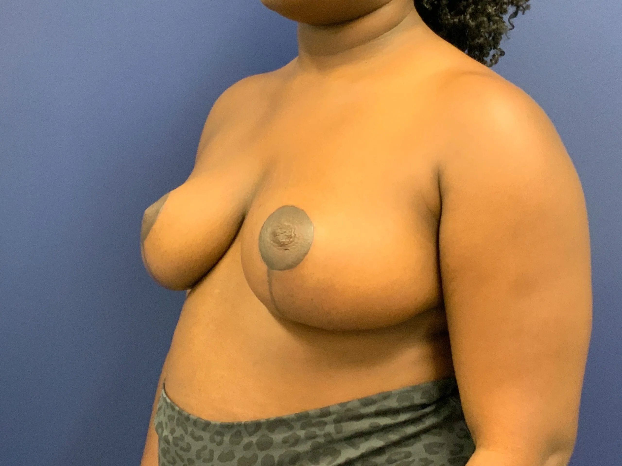 Breast-Reduction-Case--7783 | After Breast Reduction 5