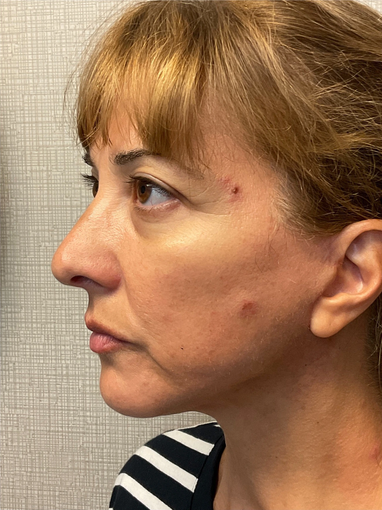 Facelift-Case--8368 | After Facelift 4