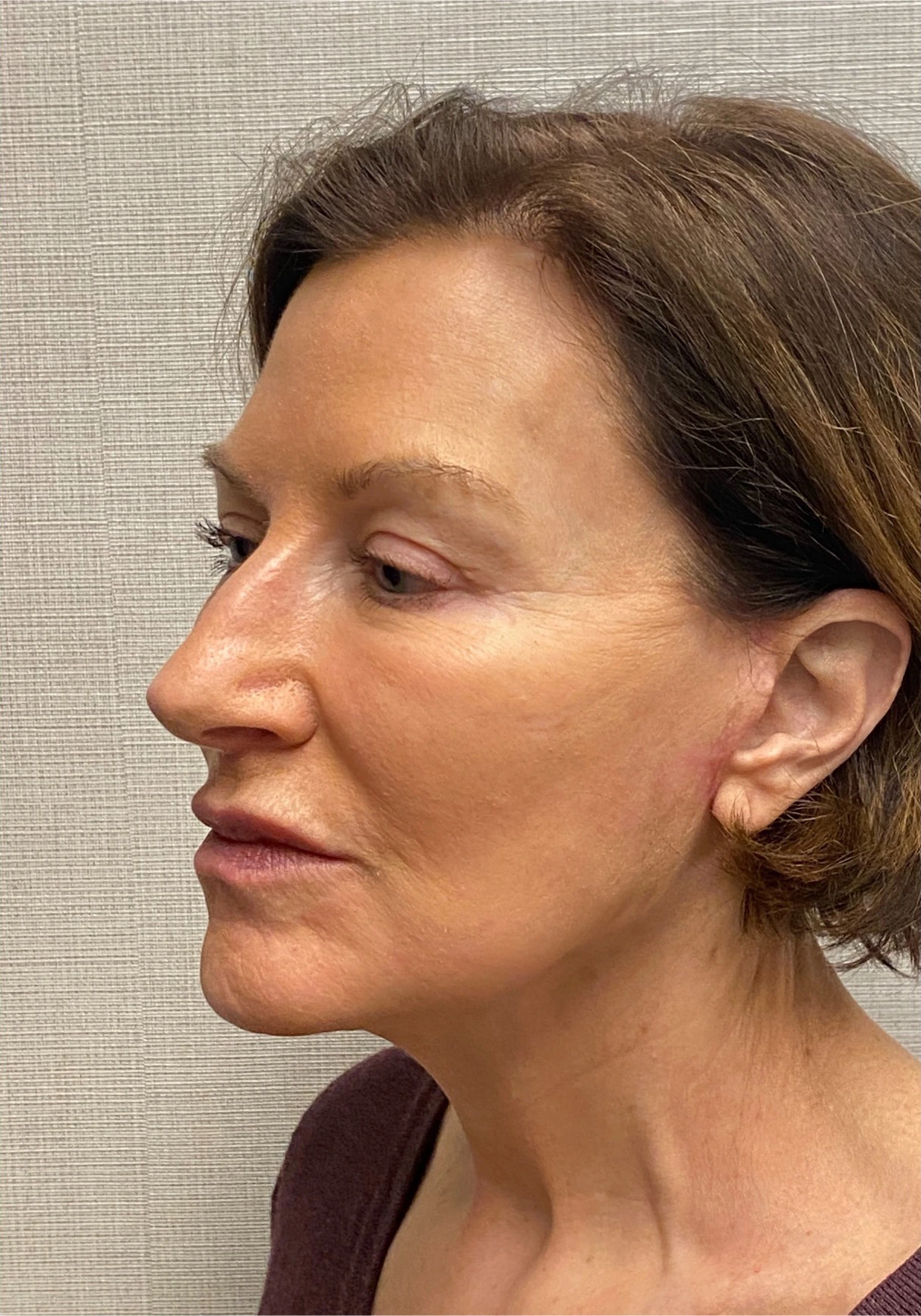 Facelift-Case--6591 | After Facelift 4