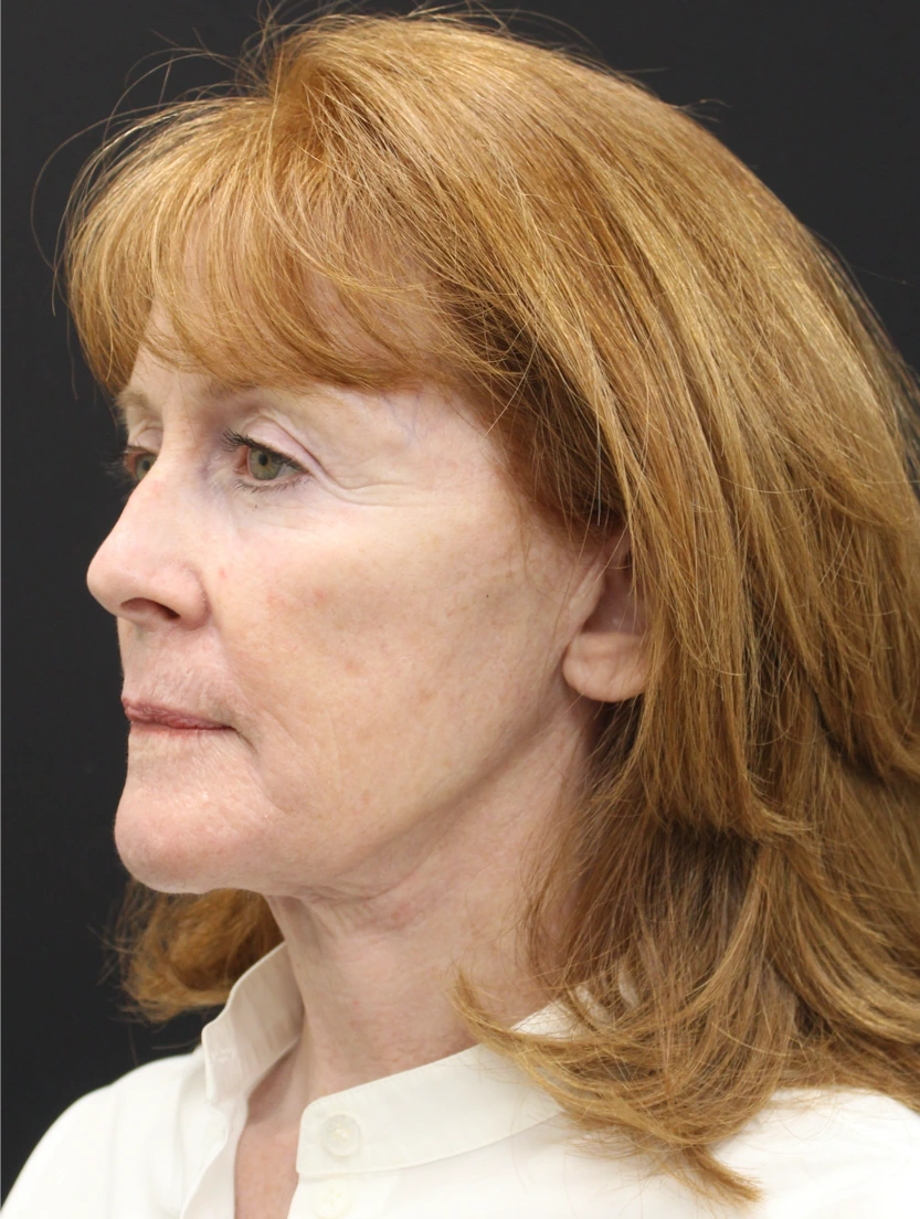 Face-and-Neck-Lift-Case--9302 | After Facelift 3
