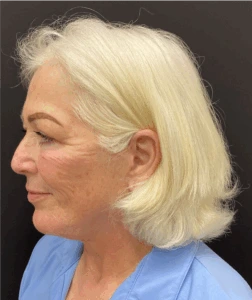 Necklift-Case--7769 | After Neck Lift 2