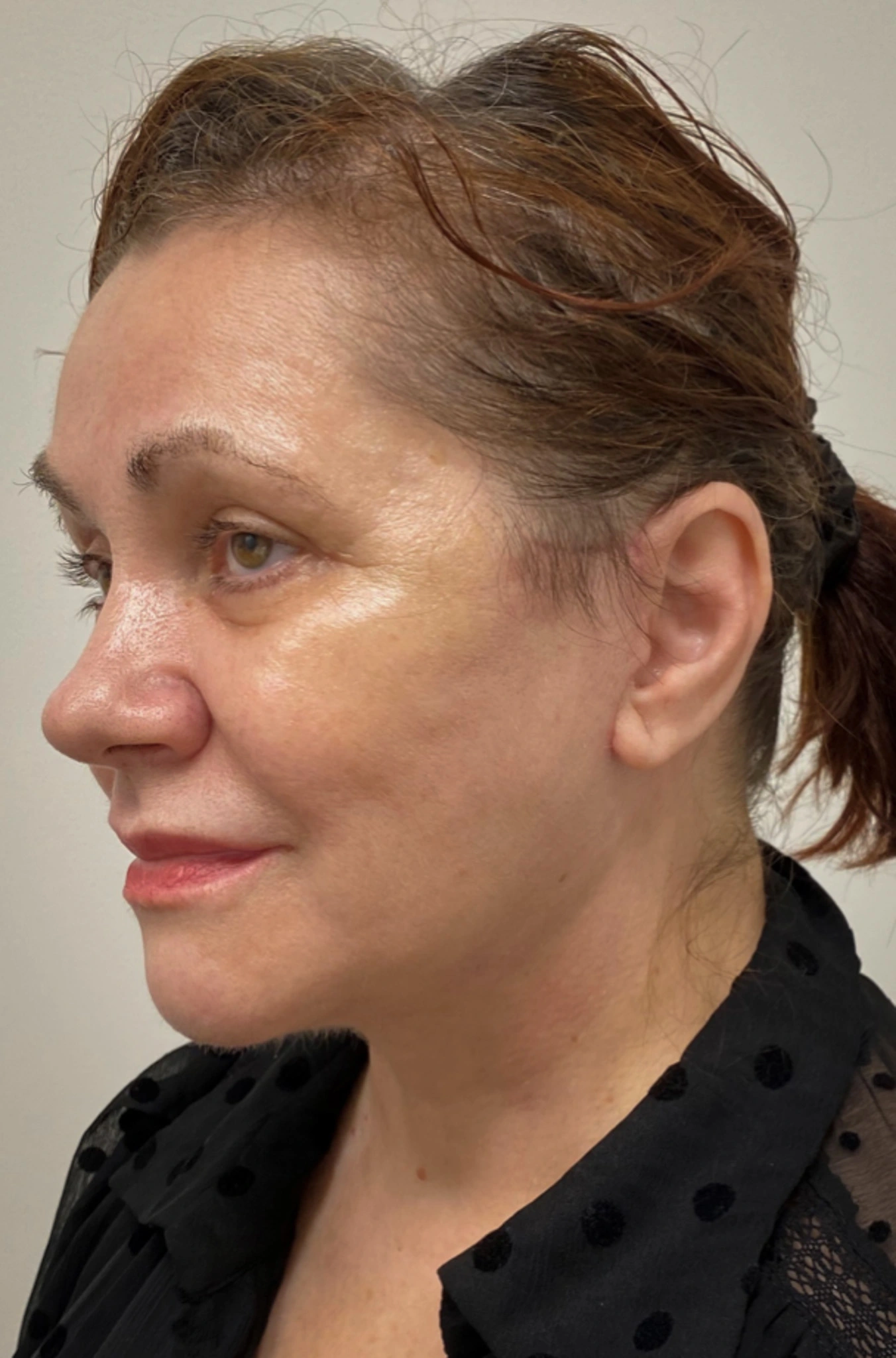 Facelift-Case--6254 | After Facelift 4