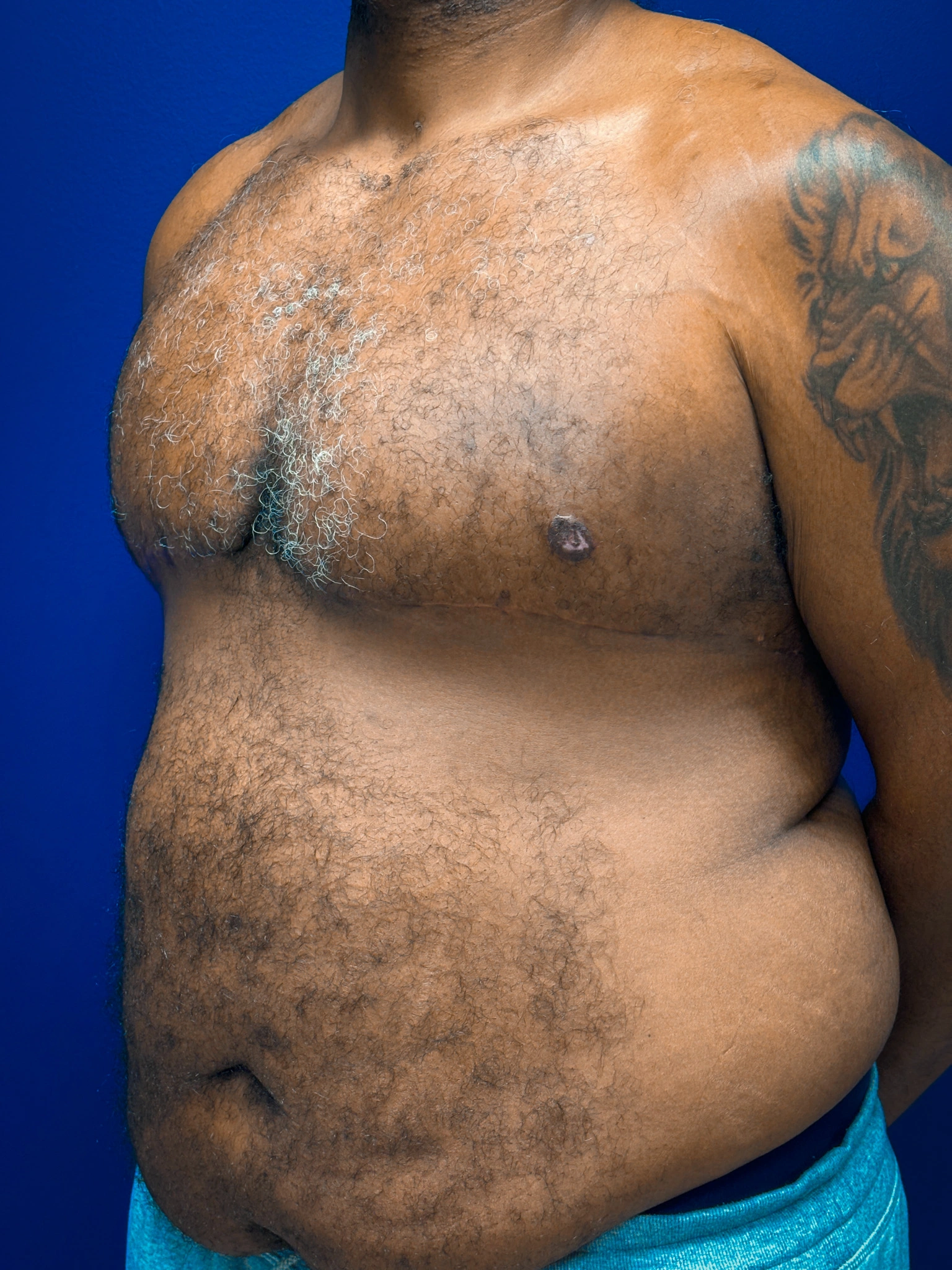 Gynecomastia-Case--4473 | After Gynecomastia / Male Breast Reduction 5