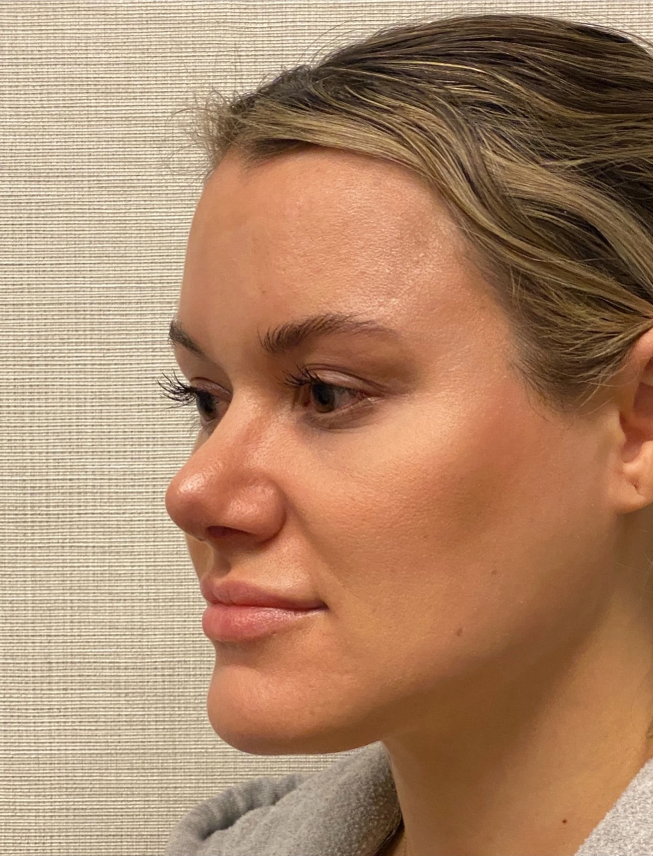 Rhinoplasty-Case--4972 | After Rhinoplasty 5