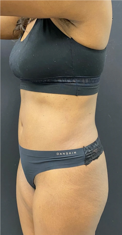 Abdominoplasty-Case--6650 | After Liposuction 4