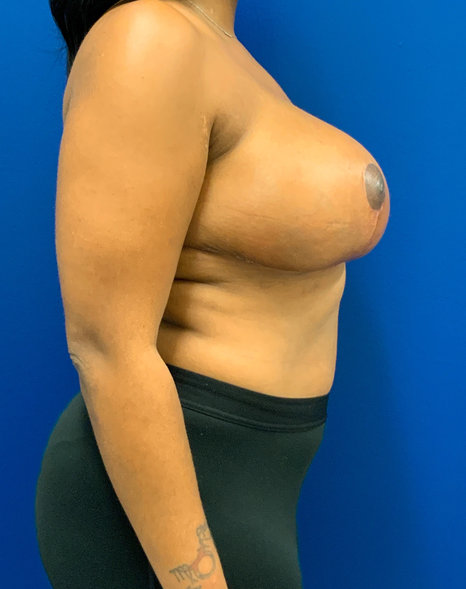 Breast-Reduction-Case--9235 | After Breast Reduction 3