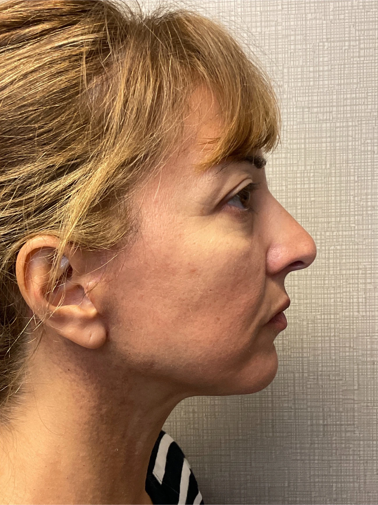 Facelift-Case--8368 | After Facelift 3