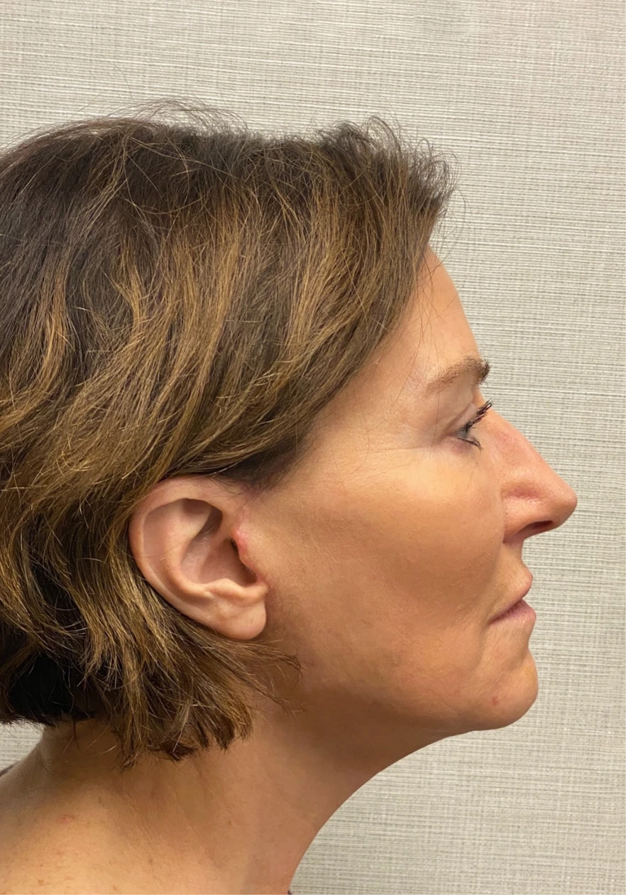 Facelift-Case--6591 | After Facelift 3