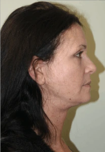 Face-and-Neck-Lift-Case--9403 | After Neck Lift 2