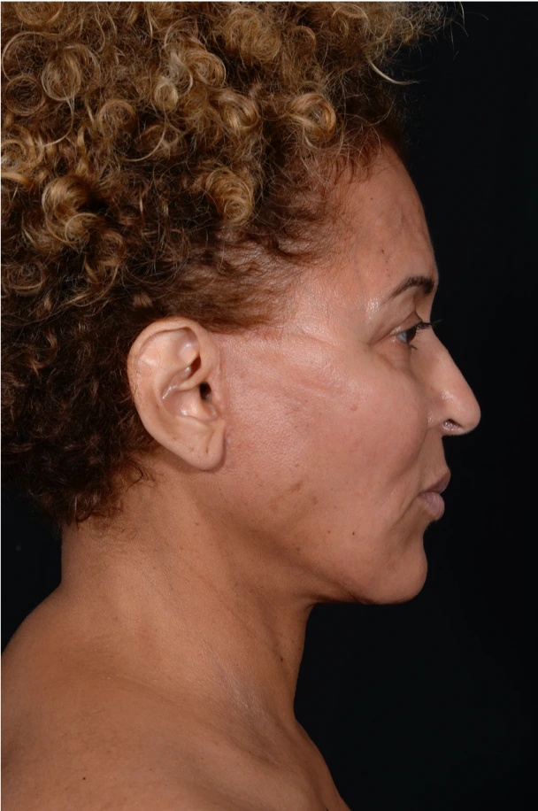 Face-and-Neck-Lift-Case--3772 | After Facelift 3