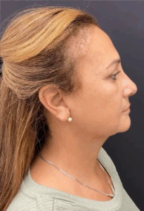 Rhinoplasty-Case--8713 | After Rhinoplasty 2