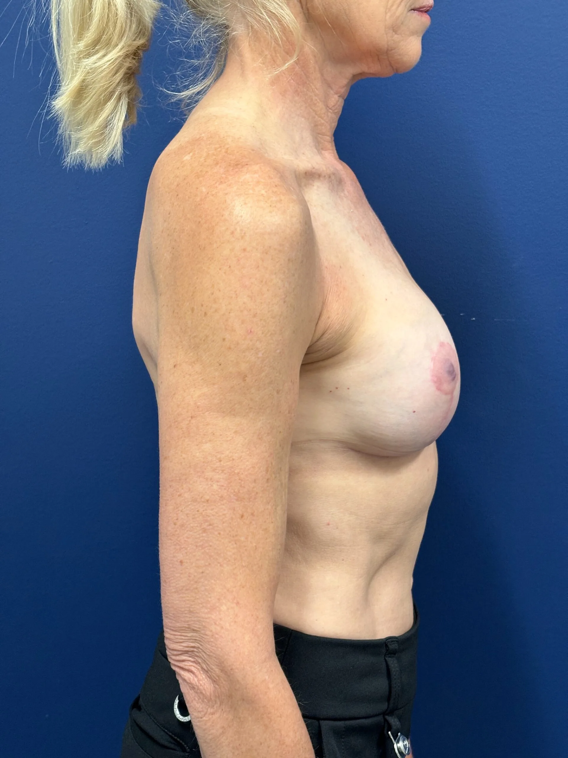 Revision-Breast-Augmentation-Case--9027 | After Revision Augmentation 2