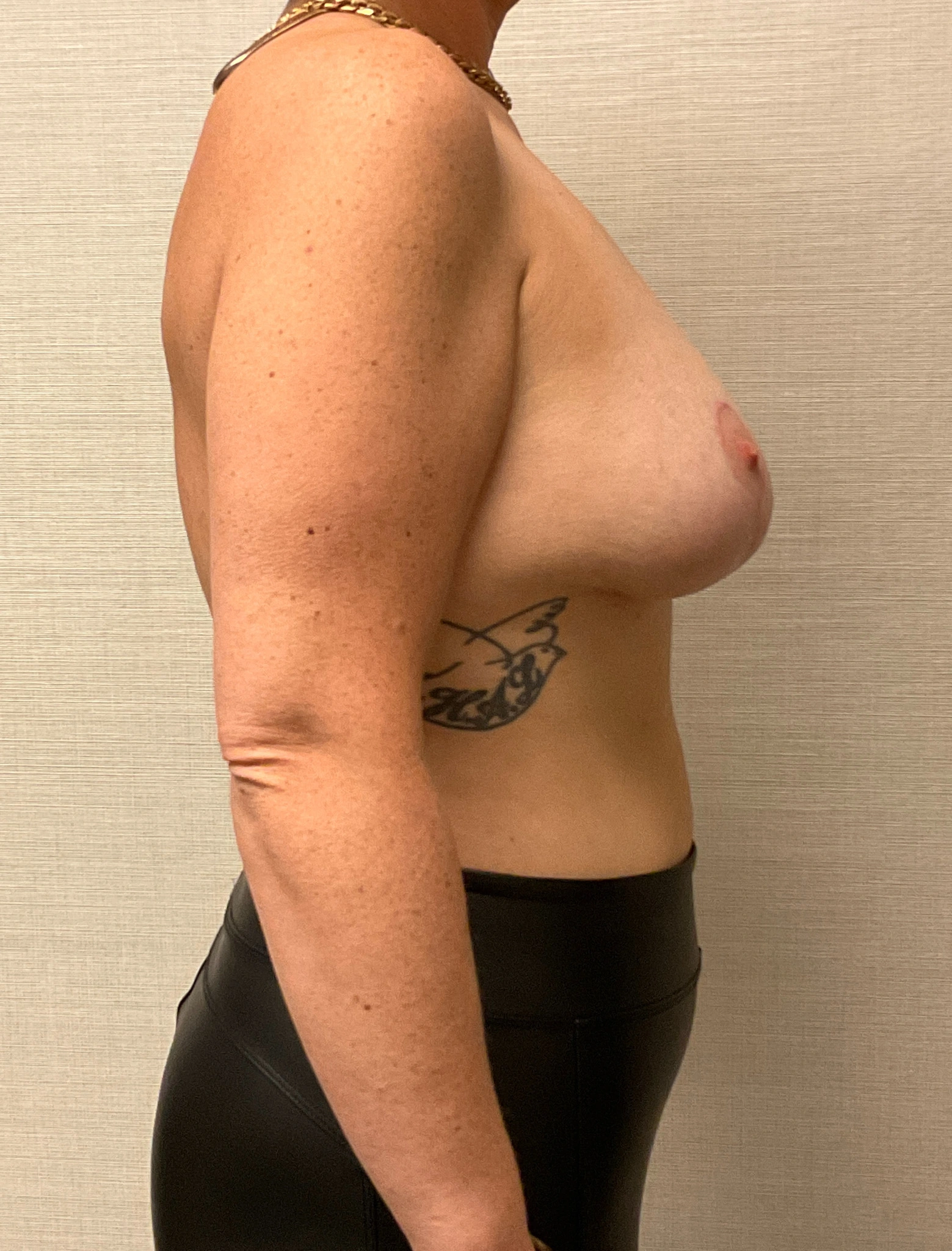 Augmentation-Mastopexy-Case--6658 | After Breast Augmentation With Lift 2