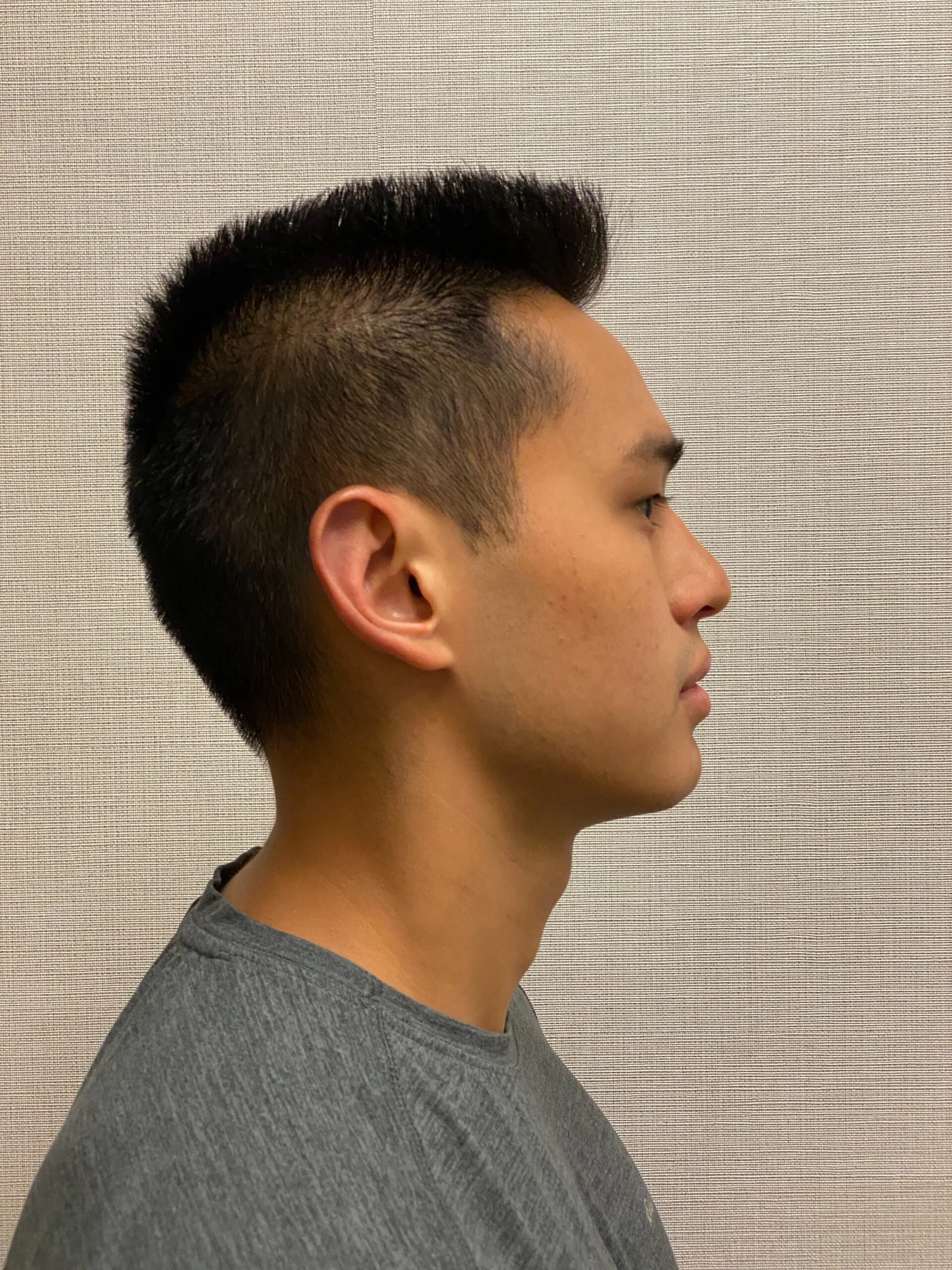 Otoplasty-Case--2681 | After Otoplasty 3