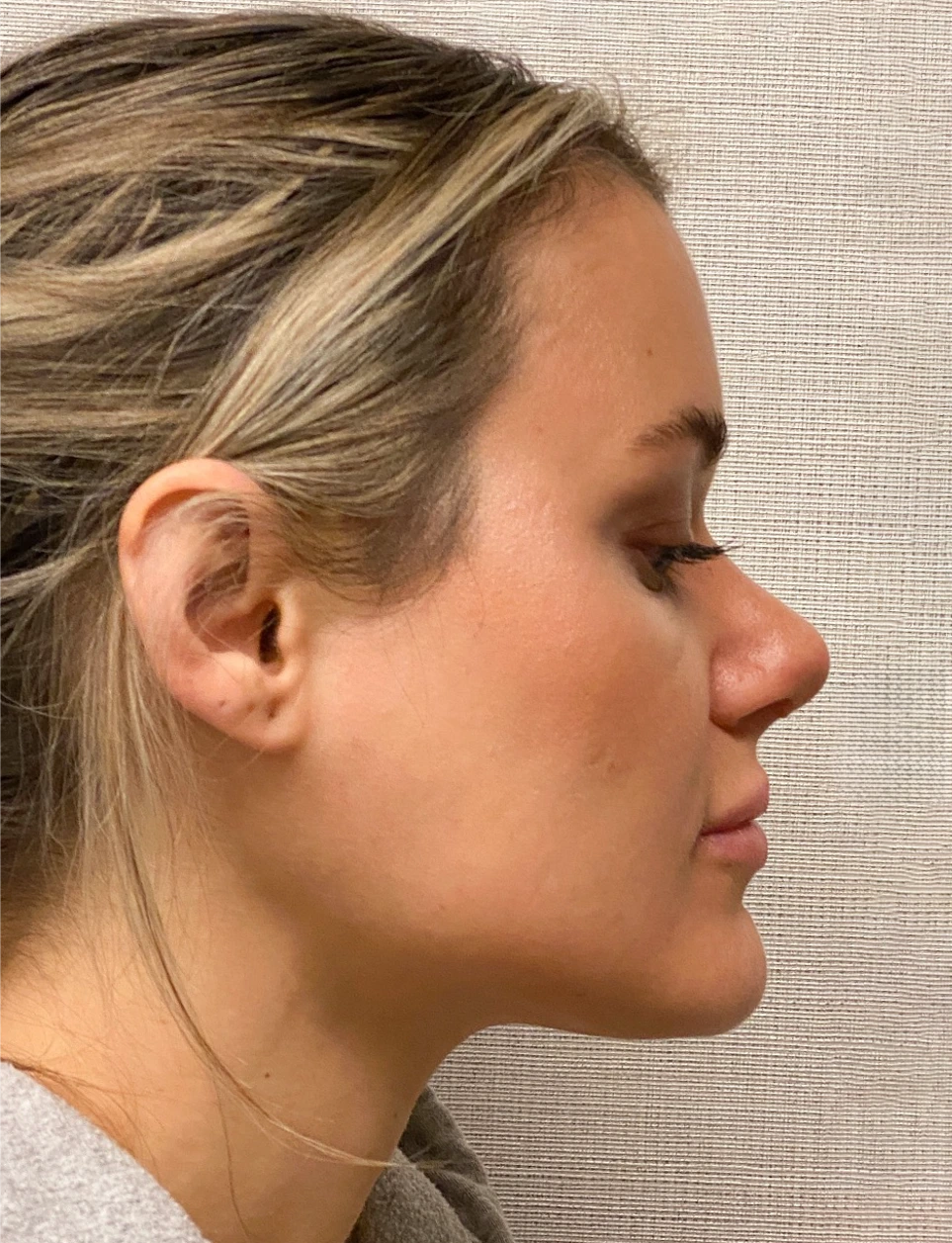Rhinoplasty-Case--4972 | After Rhinoplasty 3