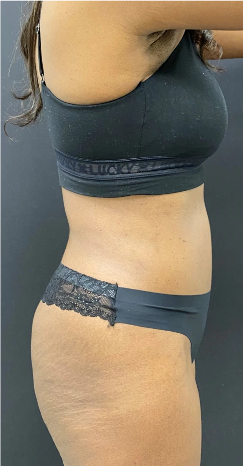 Abdominoplasty-Case--6650 | After Liposuction 3
