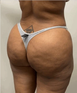 Brazilian-Butt-Lift-Case--7979 | After Brazilian Butt Lift 2