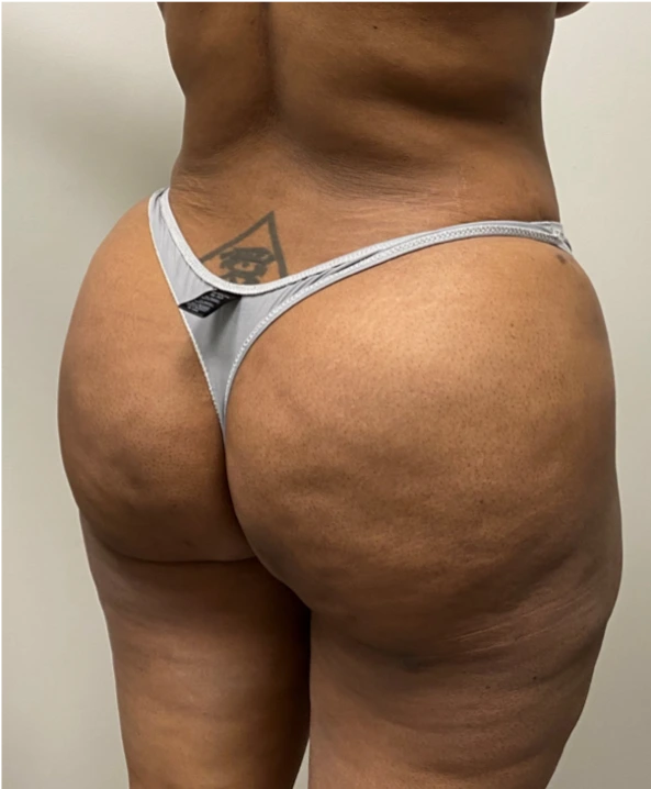Brazilian-Butt-Lift-Case--7979 | After Brazilian Butt Lift 2