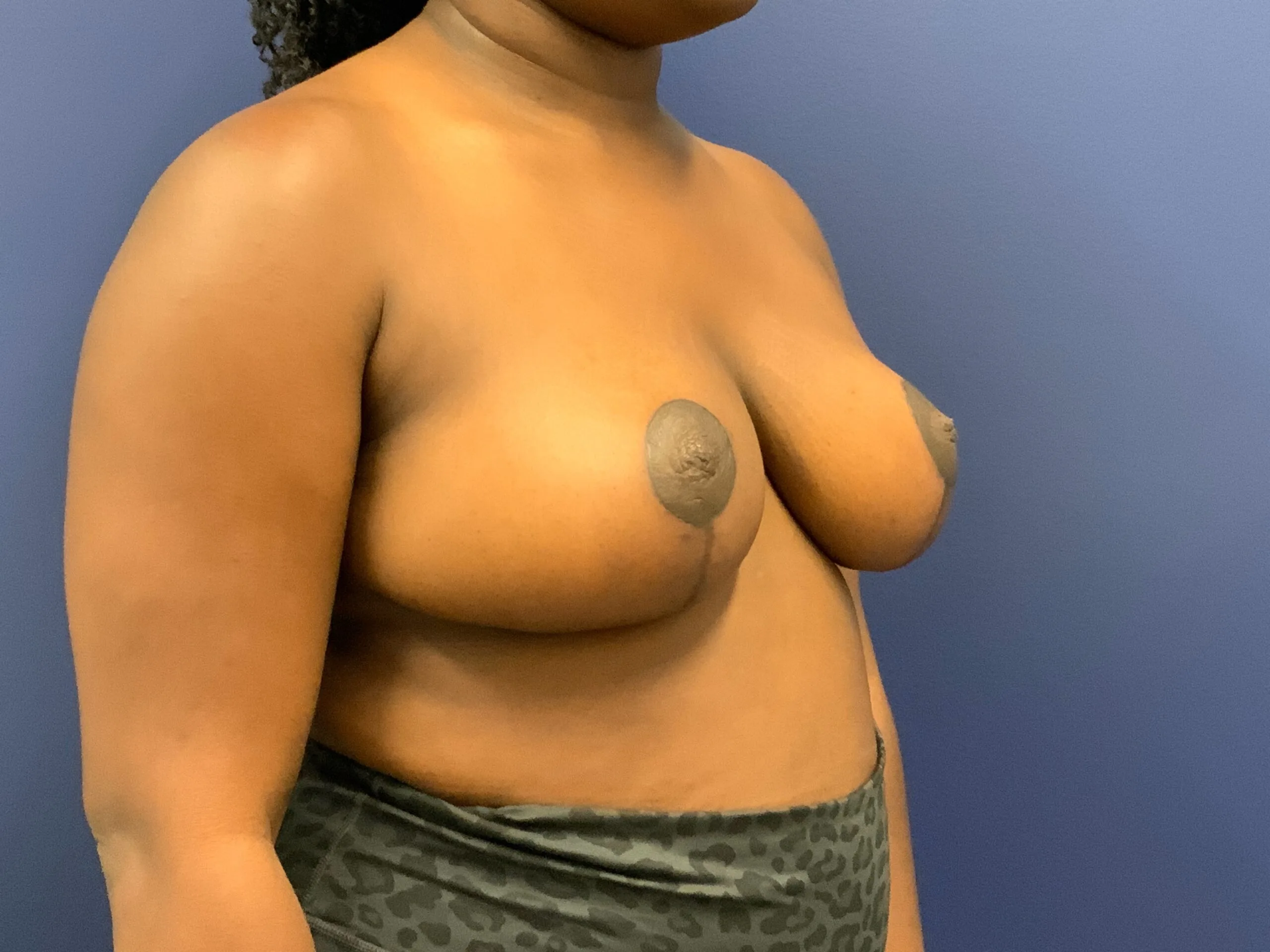 Breast-Reduction-Case--7783 | After Breast Reduction 4