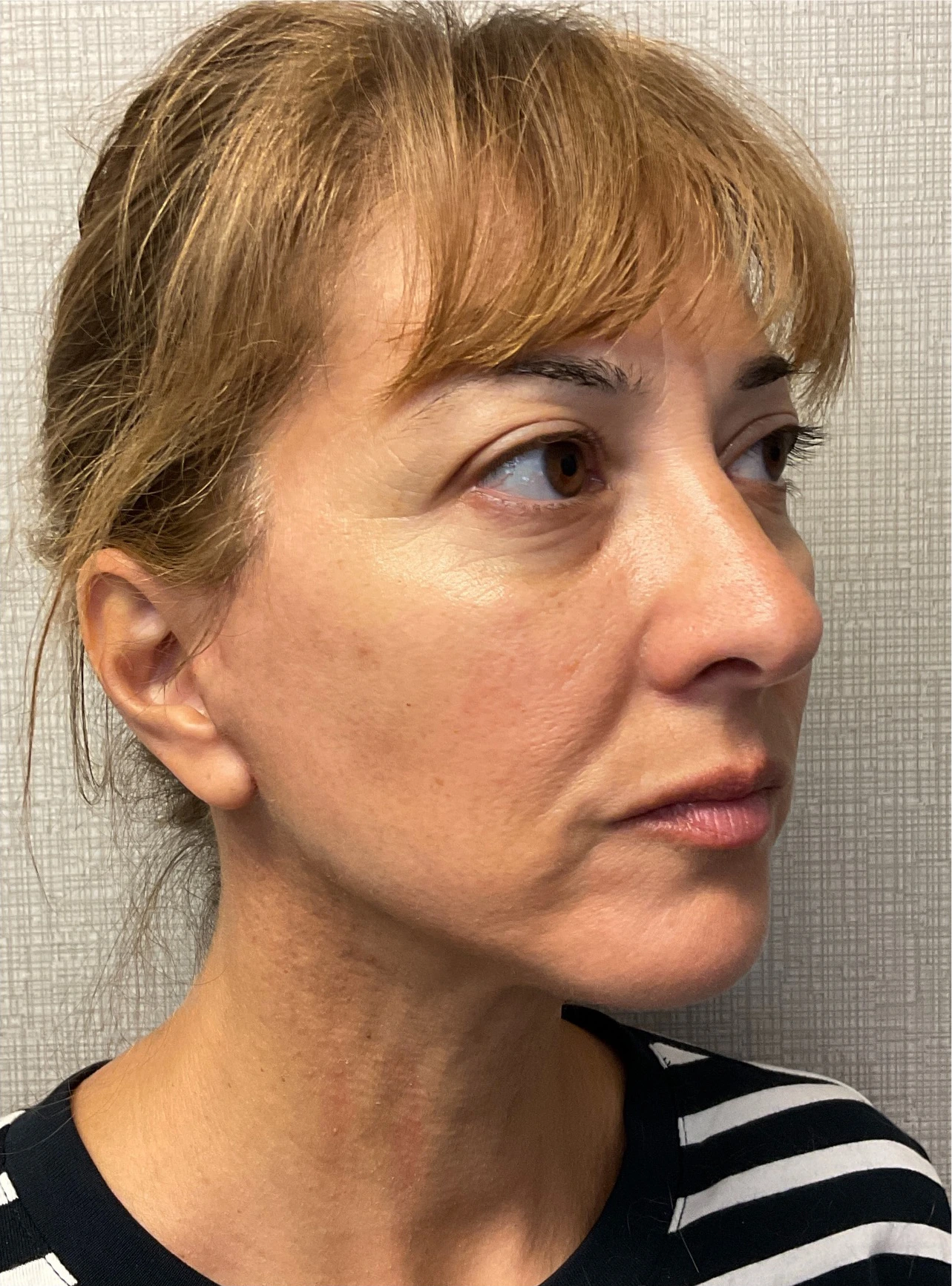 Facelift-Case--8368 | After Facelift 5