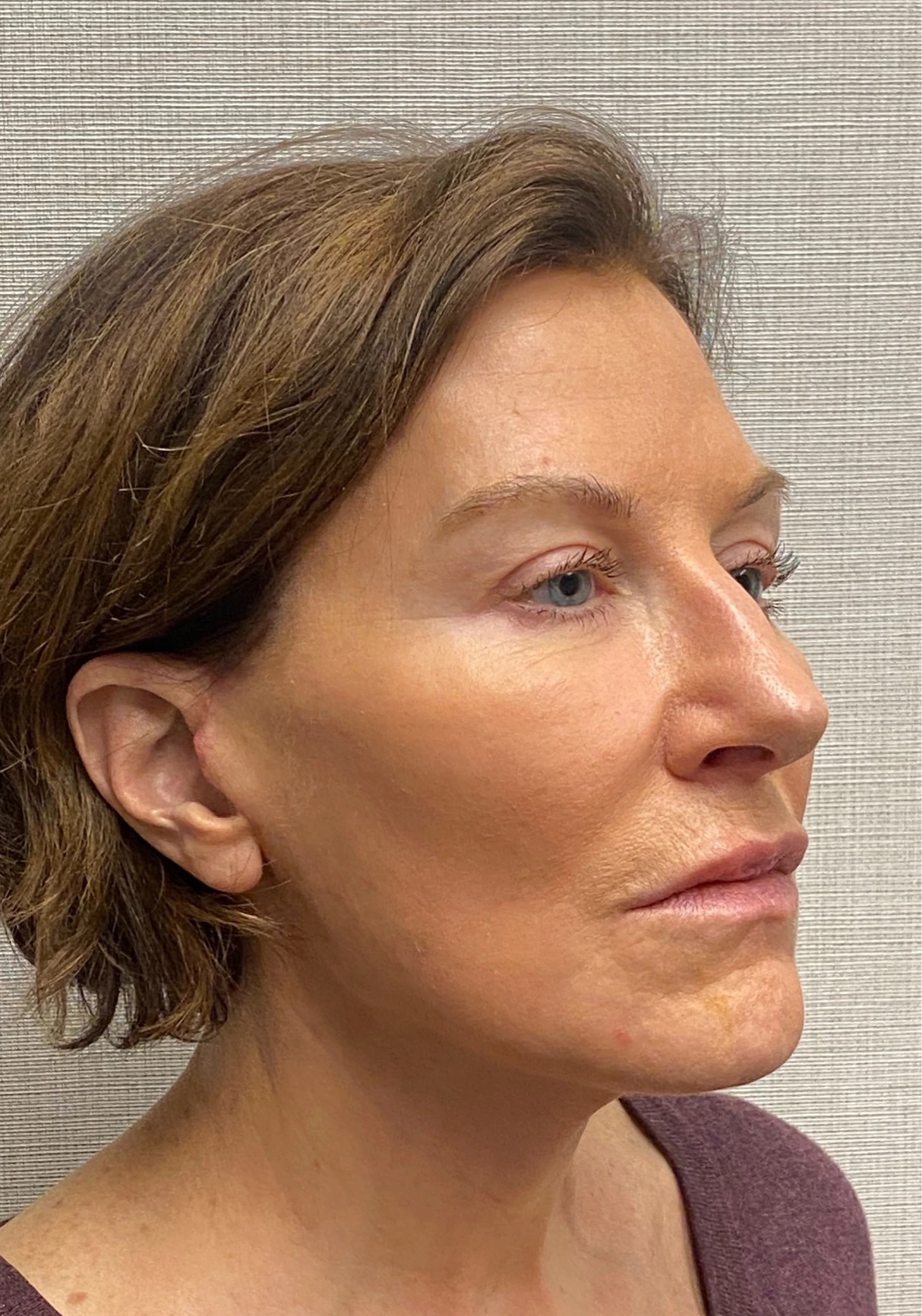 Facelift-Case--6591 | After Facelift 5